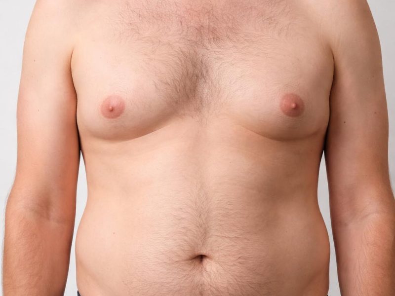 20260216_1452_Homem com Ginecomastia_simple_compose_01khks9er5e5g852z12j9wws11