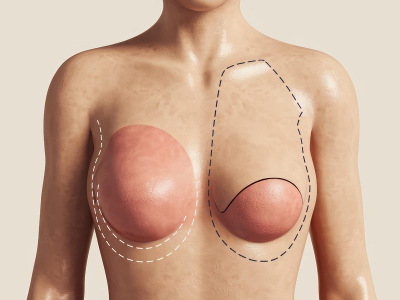 This piece serves as a poignant exploration of a woman's body rendered digitally highlighting the delicate balance between artistic expression and the realities of medical experiences such as mastectomy. It invites viewers to consider themes of identity body image and the evolving representations of femininity in art.